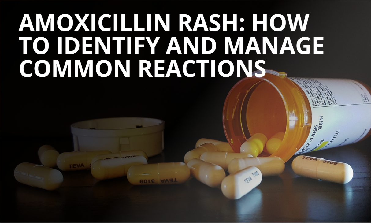 amoxicillin rash